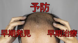 AGAは予防・早期発見・早期治療が命！｜超低コストの薄毛対策を徹底解説！